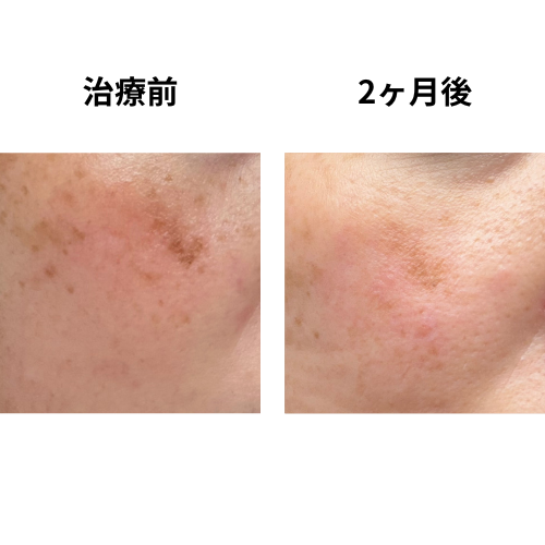 2ヶ月（4月下旬）のシミの様子