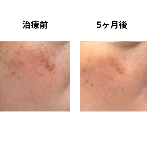 5ヶ月後
